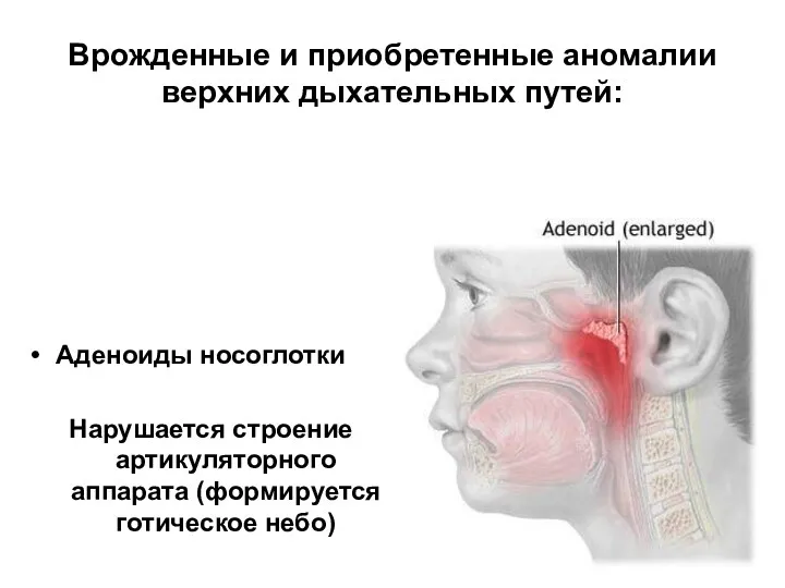 Врожденные и приобретенные аномалии верхних дыхательных путей: Аденоиды носоглотки Нарушается строение артикуляторного аппарата (формируется готическое небо)