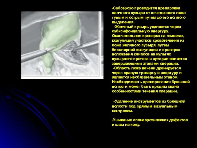 -Субсерозо проводится препаровка желчного пузыря от печеночного ложа тупым и