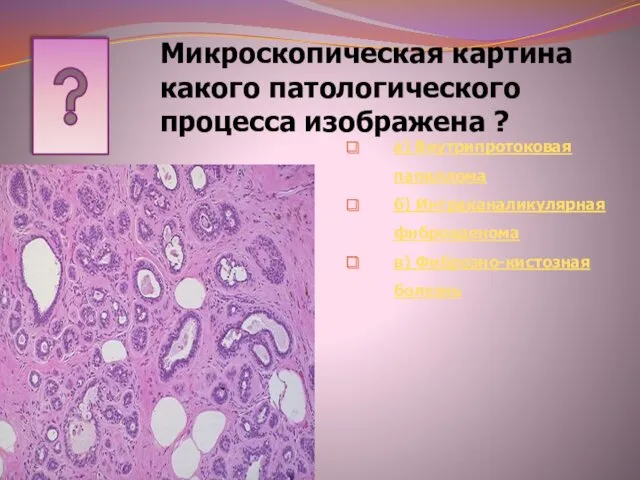 Микроскопическая картина какого патологического процесса изображена ? а) Внутрипротоковая папиллома б) Интраканаликулярная фиброаденома в) Фиброзно-кистозная болезнь