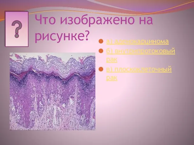 Что изображено на рисунке? а) аденокарцинома б) внутрипротоковый рак в) плоскоклеточный рак