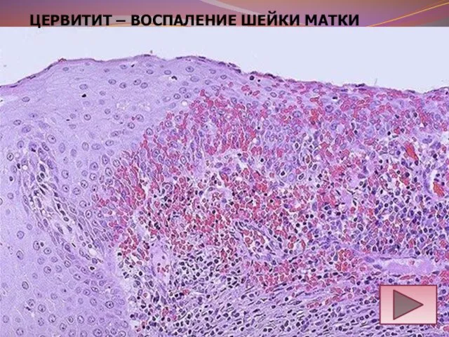 ЦЕРВИТИТ – ВОСПАЛЕНИЕ ШЕЙКИ МАТКИ