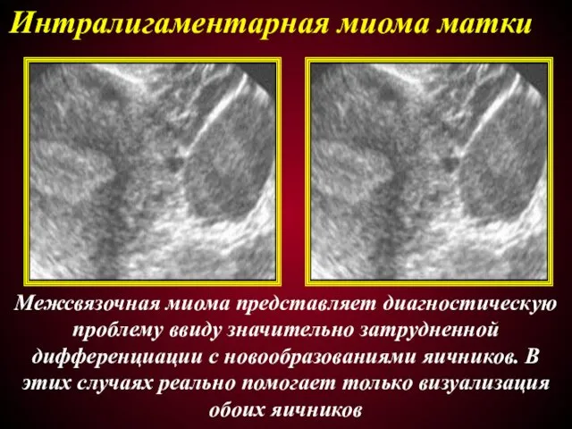 Интралигаментарная миома матки Межсвязочная миома представляет диагностическую проблему ввиду значительно
