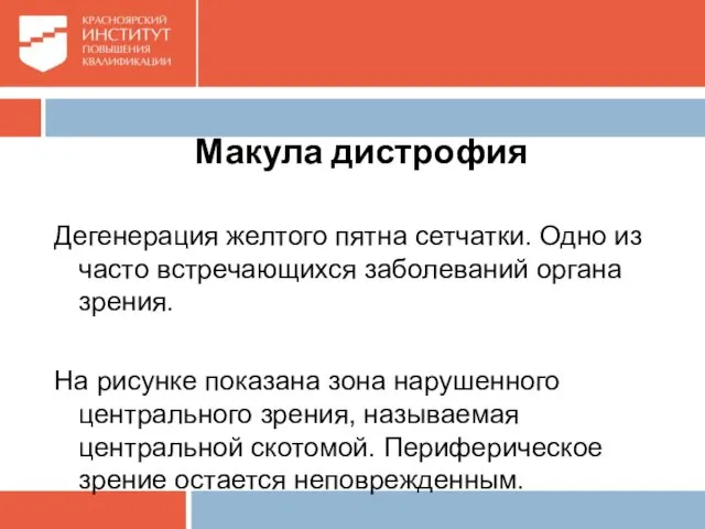 Макула дистрофия Дегенерация желтого пятна сетчатки. Одно из часто встречающихся