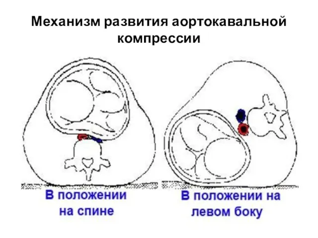 Механизм развития аортокавальной компрессии