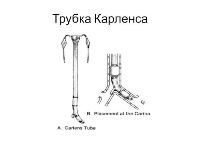 Трубка Карленса