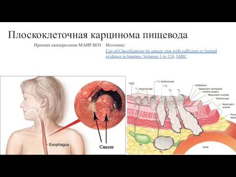 Плоскоклеточная карцинома пищевода Признан канцерогеном МАИР ВОЗ List of Classifications