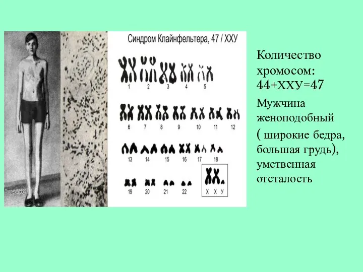 Количество хромосом: 44+ХХУ=47 Мужчина женоподобный ( широкие бедра, большая грудь), умственная отсталость