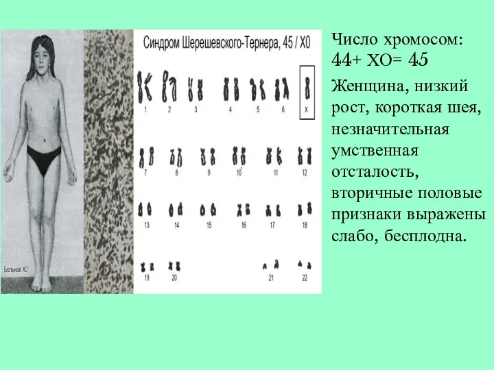 Число хромосом: 44+ ХО= 45 Женщина, низкий рост, короткая шея,