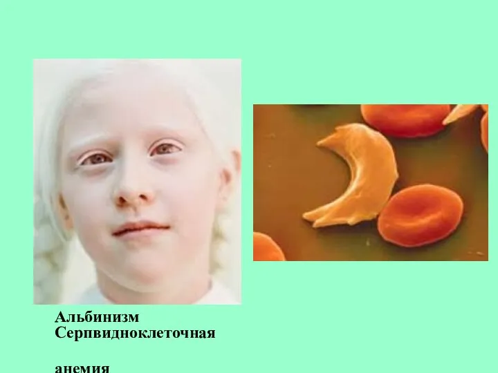 Альбинизм Серпвидноклеточная анемия