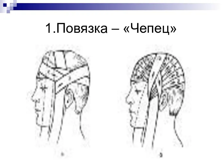 1.Повязка – «Чепец»