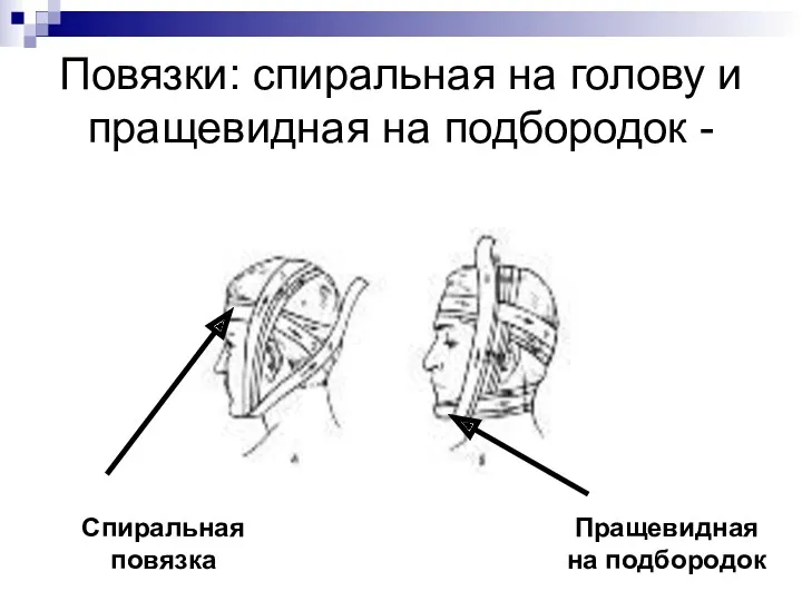 Повязки: спиральная на голову и пращевидная на подбородок - Спиральная повязка Пращевидная на подбородок