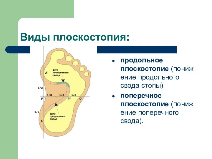 Виды плоскостопия: продольное плоскостопие (понижение продольного свода стопы) поперечное плоскостопие (понижение поперечного свода).