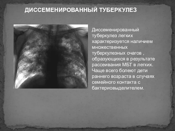 ДИССЕМЕНИРОВАННЫЙ ТУБЕРКУЛЕЗ Диссеменированный туберкулез легких характеризуется наличием множественных туберкулезных очагов