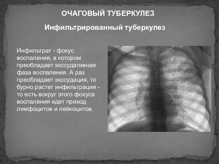 Инфильтрированный туберкулез ОЧАГОВЫЙ ТУБЕРКУЛЕЗ Инфильтрат - фокус воспаления, в котором