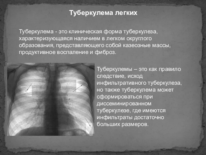 Туберкулема легких Туберкулема - это клиническая форма туберкулеза, характеризующаяся наличием