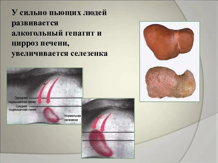 У сильно пьющих людей развивается алкогольный гепатит и цирроз печени, увеличивается селезенка