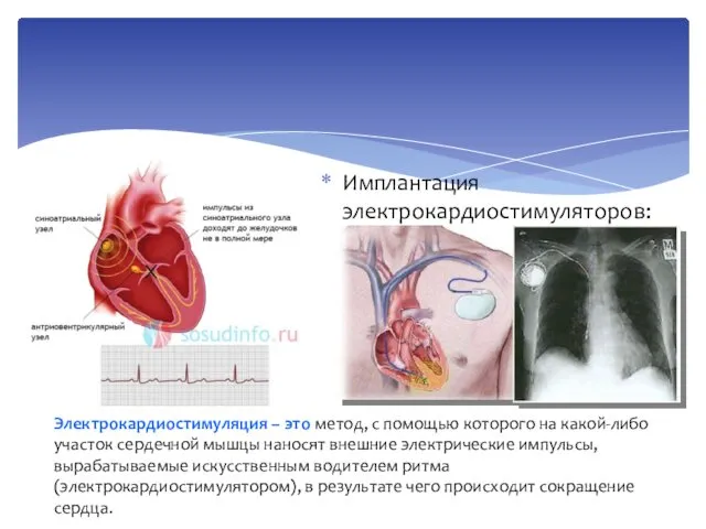 Имплантация электрокардиостимуляторов: Электрокардиостимуляция – это метод, с помощью которого на