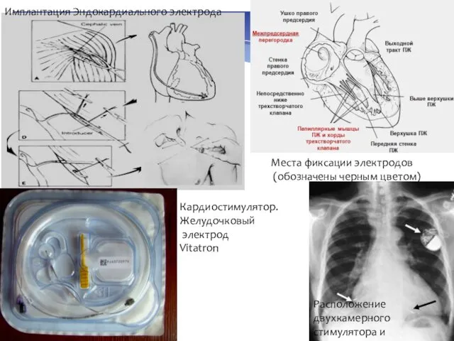 Места фиксации электродов (обозначены черным цветом) Имплантация Эндокардиального электрода Расположение