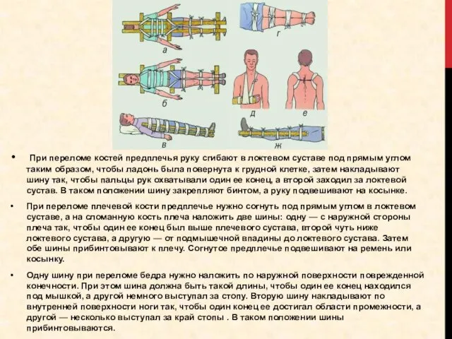 При переломе костей предплечья руку сгибают в локтевом суставе под