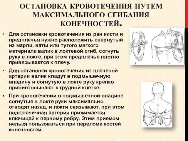 ОСТАНОВКА КРОВОТЕЧЕНИЯ ПУТЕМ МАКСИМАЛЬНОГО СГИБАНИЯ КОНЕЧНОСТЕЙ. Для остановки кровотечения из