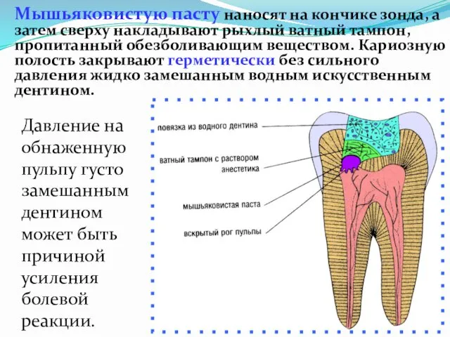 Мышьяковистую пасту наносят на кончике зонда, а затем сверху накладывают