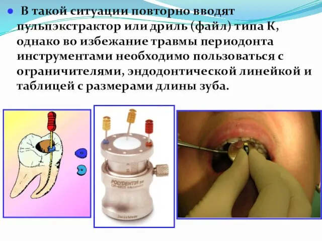 ● В такой ситуации повторно вводят пульпэкстрактор или дриль (файл)