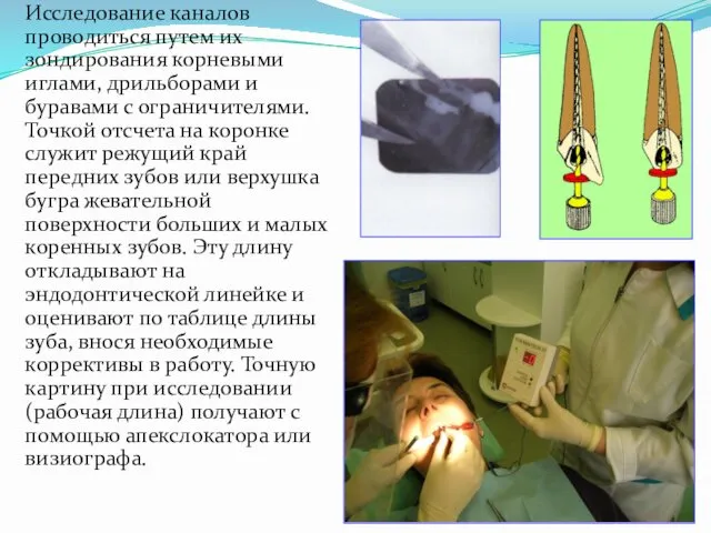 Исследование каналов проводиться путем их зондирования корневыми иглами, дрильборами и