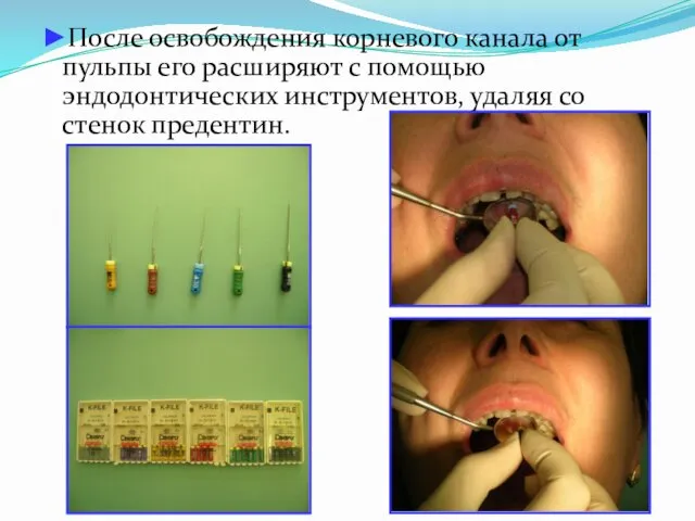 ►После освобождения корневого канала от пульпы его расширяют с помощью эндодонтических инструментов, удаляя со стенок предентин.