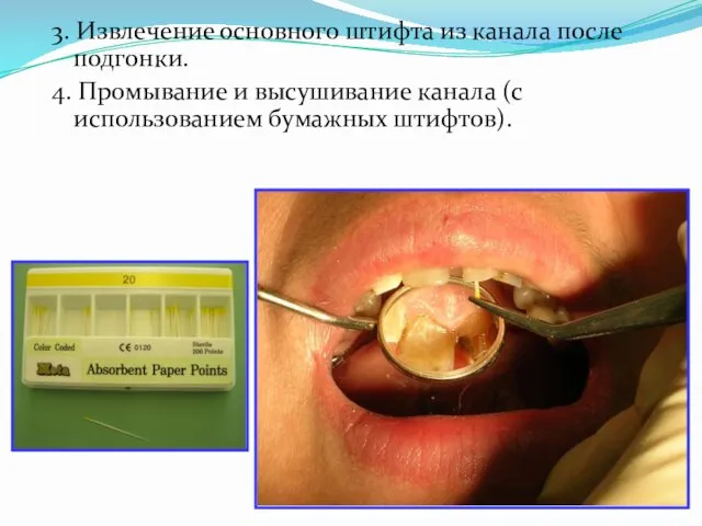 3. Извлечение основного штифта из канала после подгонки. 4. Промывание