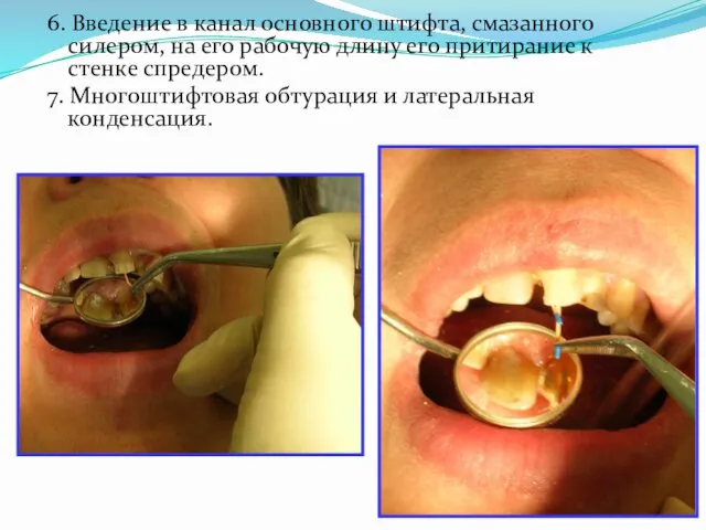 6. Введение в канал основного штифта, смазанного силером, на его