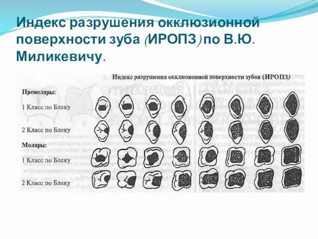 Индекс разрушения окклюзионной поверхности зуба (ИРОПЗ) по В.Ю. Миликевичу.