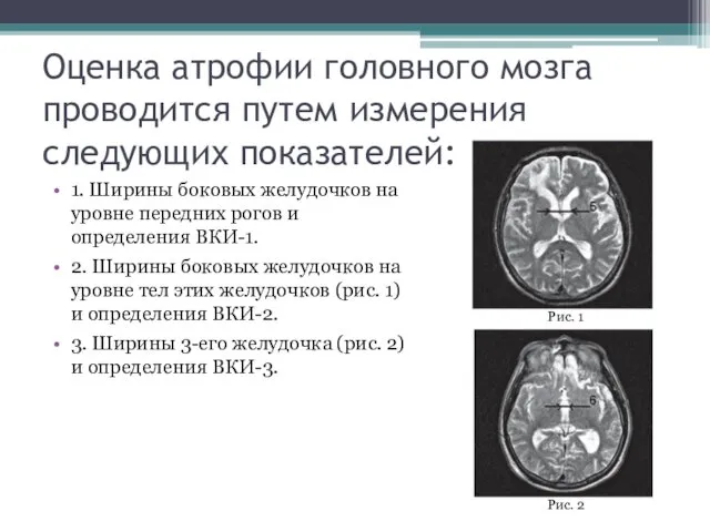 Оценка атрофии головного мозга проводится путем измерения следующих показателей: 1.