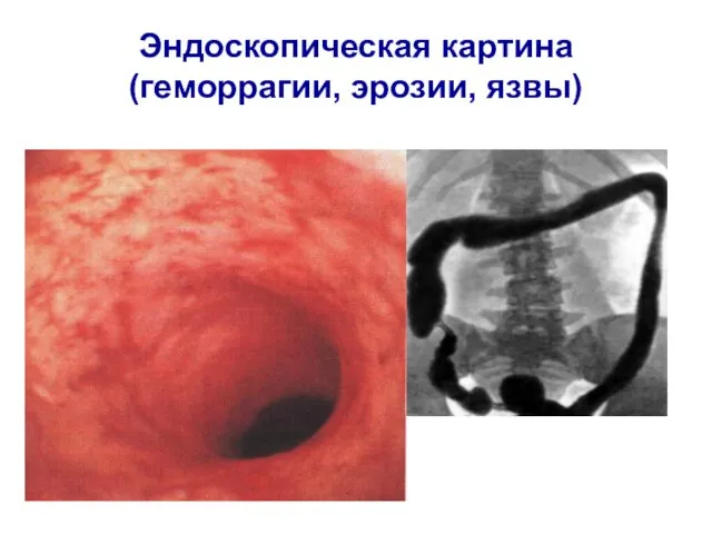 Эндоскопическая картина (геморрагии, эрозии, язвы)