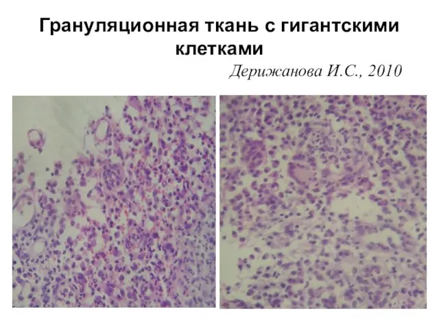 Грануляционная ткань с гигантскими клетками Дерижанова И.С., 2010