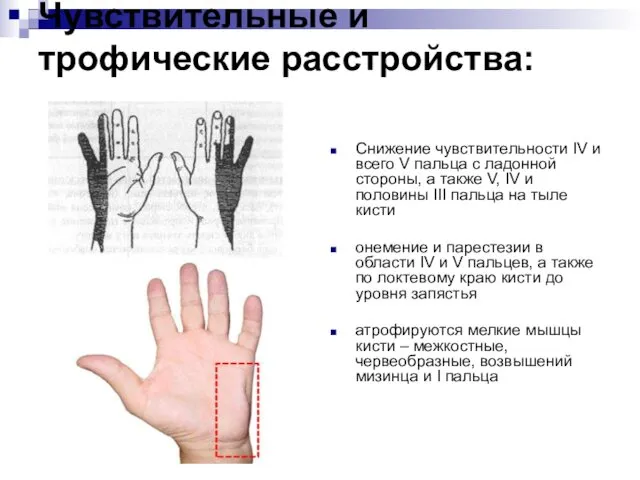 Чувствительные и трофические расстройства: Снижение чувствительности IV и всего V пальца с ладонной