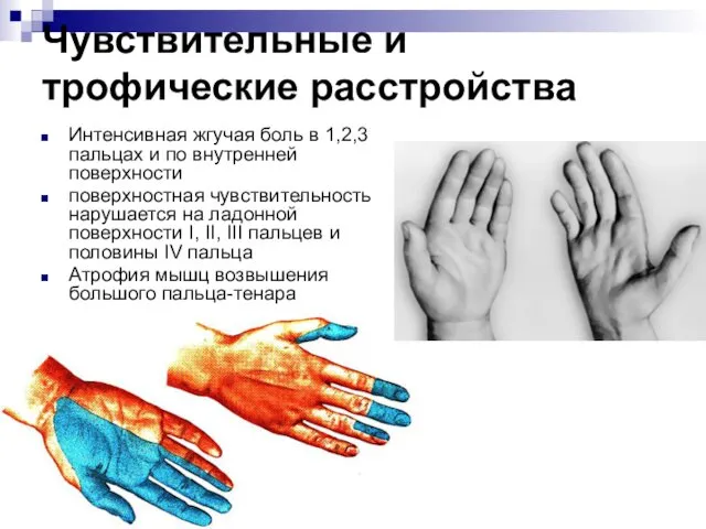 Чувствительные и трофические расстройства Интенсивная жгучая боль в 1,2,3 пальцах и по внутренней