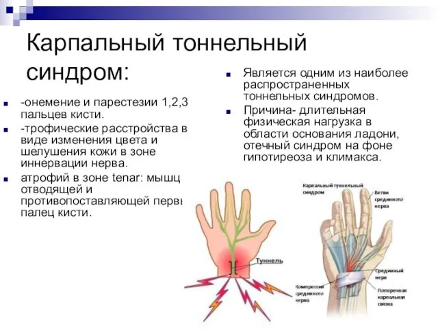 Карпальный тоннельный синдром: -онемение и парестезии 1,2,3 пальцев кисти. -трофические расстройства в виде