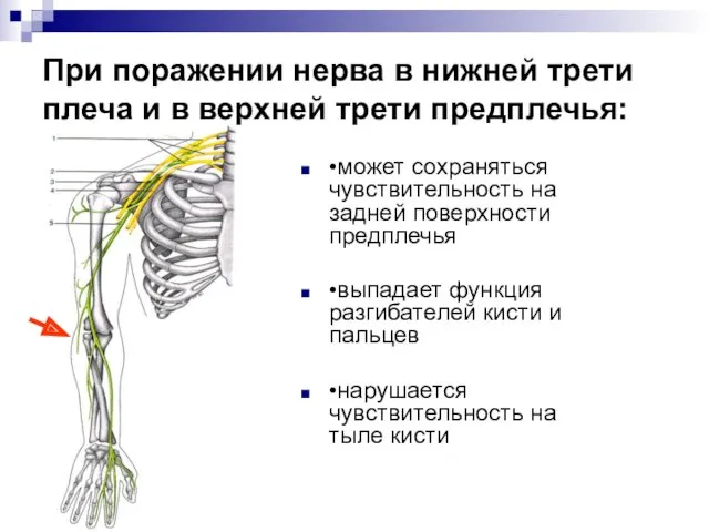 При поражении нерва в нижней трети плеча и в верхней трети предплечья: •может