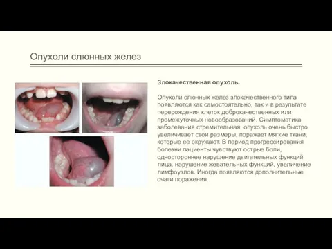 Опухоли слюнных желез Злокачественная опухоль. Опухоли слюнных желез злокачественного типа появляются как самостоятельно,