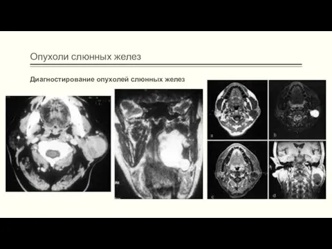 Опухоли слюнных желез Диагностирование опухолей слюнных желез