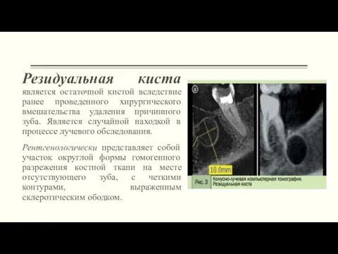 Резидуальная киста является остаточной кистой вследствие ранее проведенного хирургического вмешательства удаления причинного зуба.