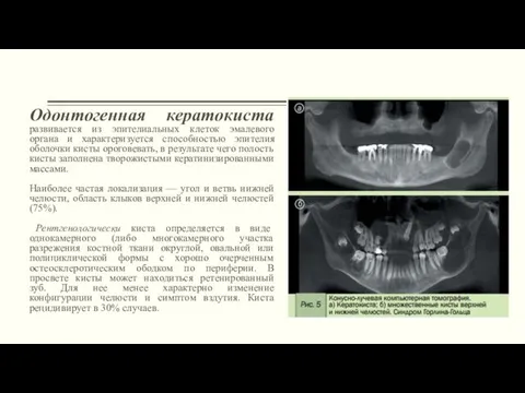 Одонтогенная кератокиста развивается из эпителиальных клеток эмалевого органа и характеризуется