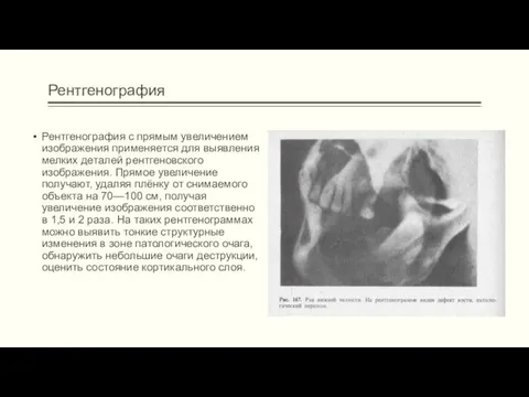 Рентгенография Рентгенография с прямым увеличением изображения применяется для выявления мелких деталей рентгеновского изображения.