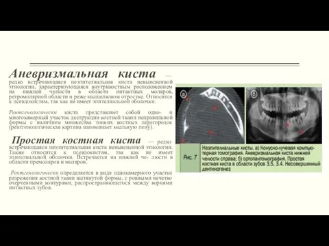 Аневризмальная киста — редко встречающаяся неэпителиальная киста невыясненной этиологии, характеризующаяся внутрикостным расположением на