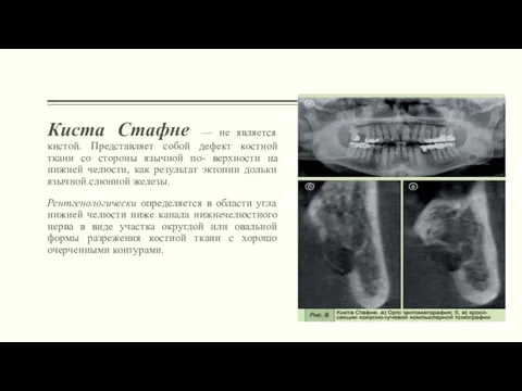 Киста Стафне — не является кистой. Представляет собой дефект костной