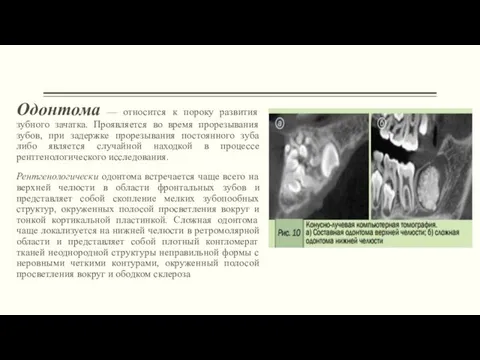 Одонтома — относится к пороку развития зубного зачатка. Проявляется во время прорезывания зубов,