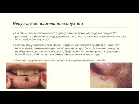 Невусы, или пигментные опухоли На слизистой оболочке полости рта у
