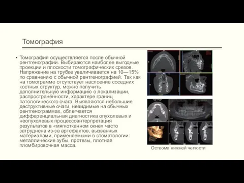 Томография Томография осуществляется после обычной рентгенографии. Выбираются наиболее выгодные проекции