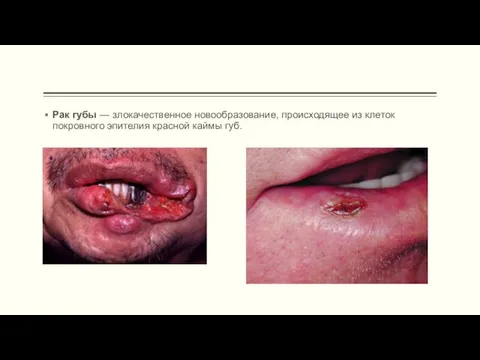 Рак губы — злокачественное новообразование, происходящее из клеток покровного эпителия красной каймы губ.