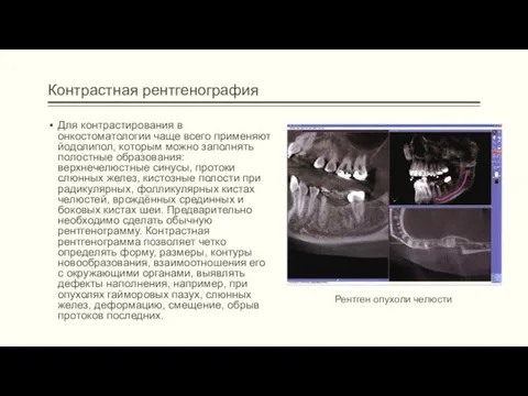 Контрастная рентгенография Для контрастирования в онкостоматологии чаще всего применяют йодолипол,